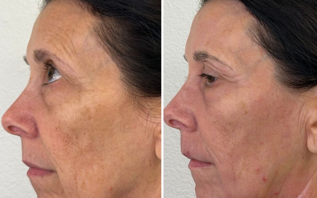CO2 Laser Resurfacing in Las Vegas | Alpha Medical Aesthetics
