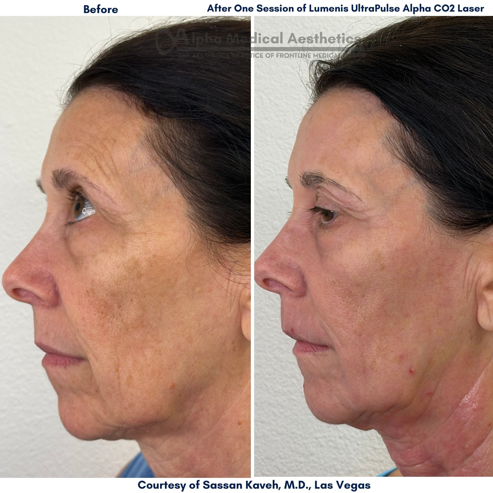 Alpha_Medical_Aesthetics_Lumenis_UltraPulse_Alpha_CO2_Laser_Before_And_After_by_Dr._Sassan_Kaveh_Las_Vegas_Henderson