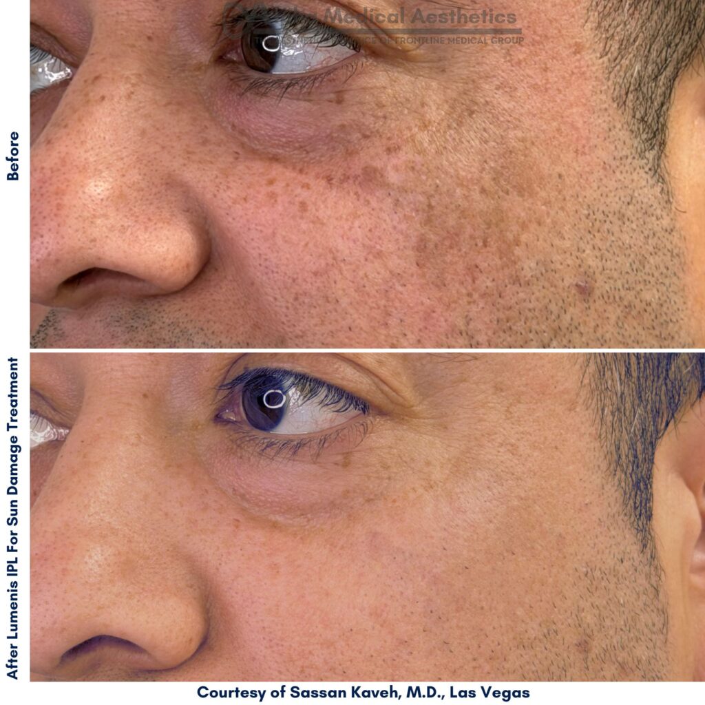 IPL Targets Pigment IPL Targets Pigment