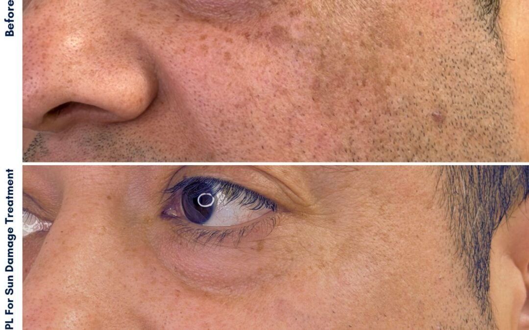 IPL Uncovered: How Advanced Light Energy Targets Stubborn Pigment, Redness, and Premature Aging