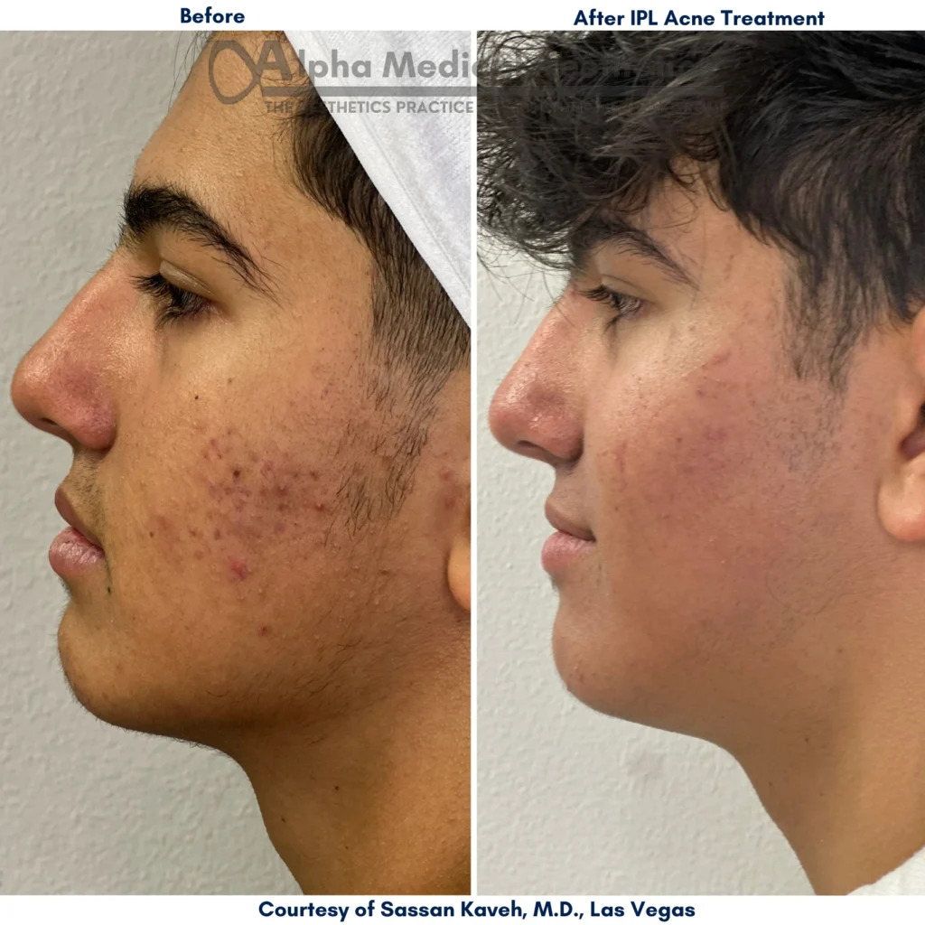 Alpha_Medical_Aesthetics_Lumenis_IPL_Therapy_for_Acne_Removal_Dr._Sassan_Kaveh_Las_Vegas Alpha_Medical_Aesthetics_Lumenis_IPL_Therapy_for_Acne_Removal_Dr._Sassan_Kaveh_Las_Vegas
