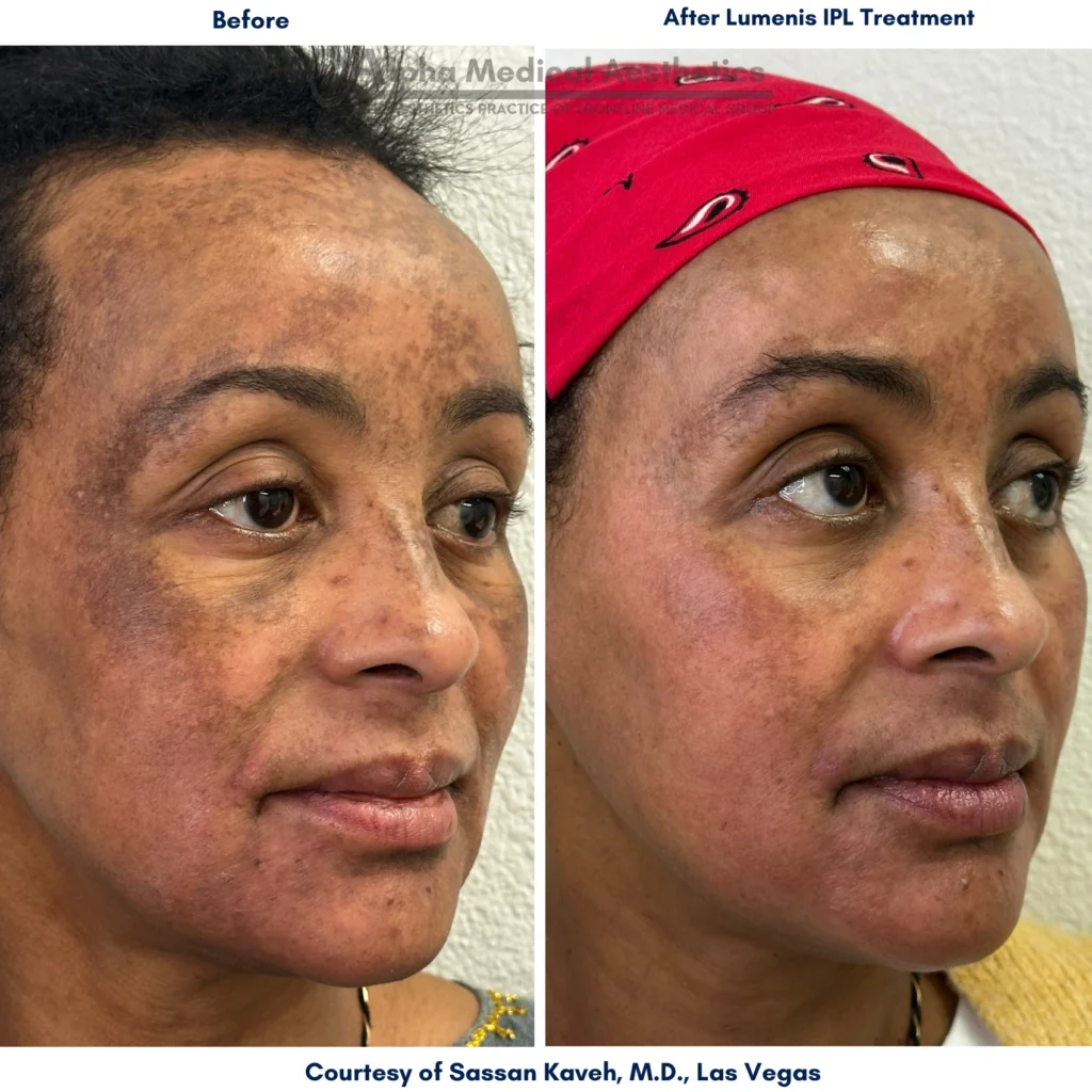 Alpha_Medical_Aesthetics_Lumenis_Stellar_M22_IPL_Therapy_To_Treat_Sun_Damage_20Minutes_From_Henderson Alpha_Medical_Aesthetics_Lumenis_Stellar_M22_IPL_Therapy_To_Treat_Sun_Damage_20Minutes_From_Henderson