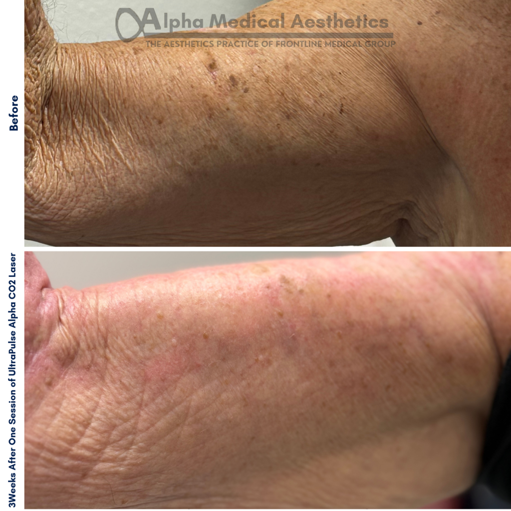 Alpha_Medical_Aesthetics_Lumenis_UltraPulse_Alpha_Co2_Laser_Medical_Spa_Henderson_Las_Vegas Alpha_Medical_Aesthetics_Lumenis_UltraPulse_Alpha_Co2_Laser_Medical_Spa_Henderson_Las_Vegas