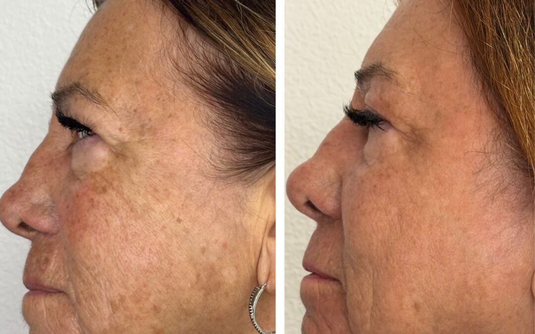 CO2 Laser Resurfacing Realistic Results, Downtime, and Cost Breakdown at Alpha Medical Aesthetics