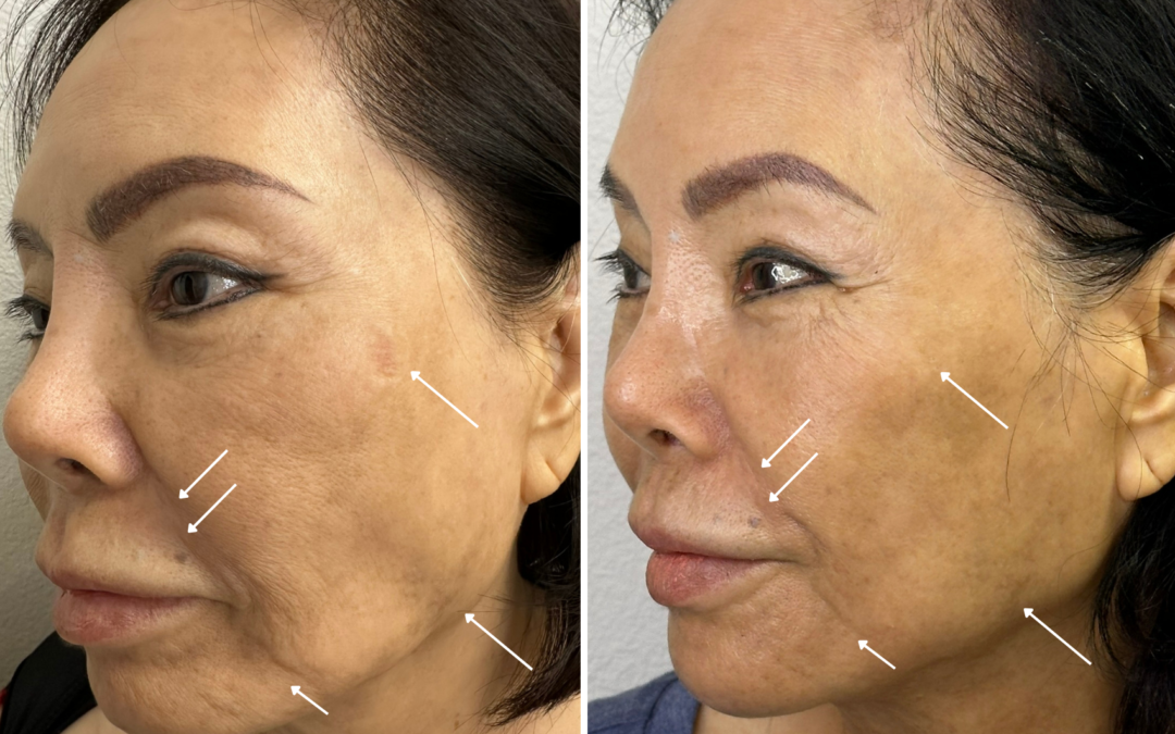 Non-Surgical Facelift in Las Vegas: triLift Before & After Results, Recovery Time, and Cost Guide for 2025