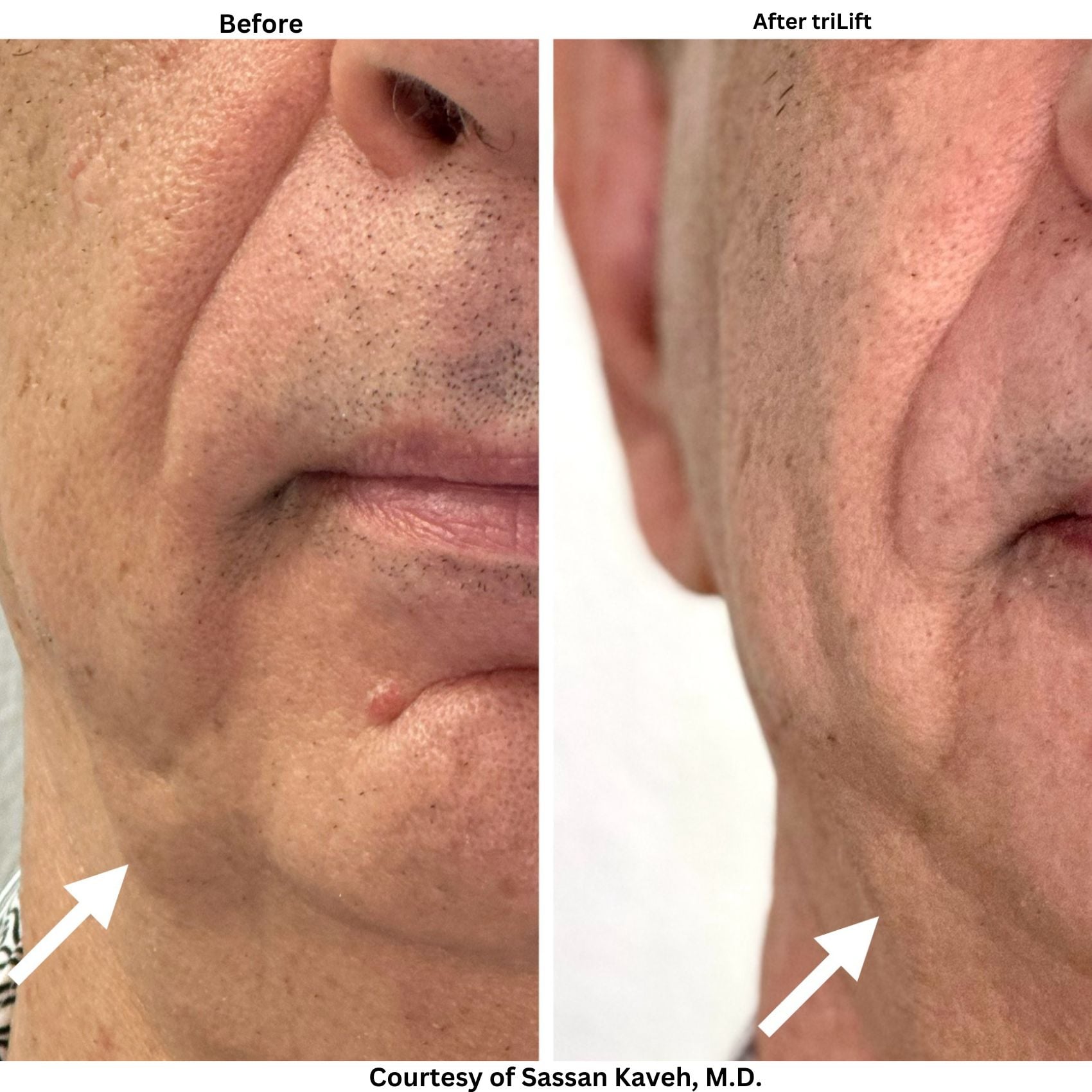 Alpha_Medical_Aesthetics_Lumenis_triLift_Non_Surgical_Facelift_Options_in_Las_Vegas_By_Dr._Sassan_Kaveh