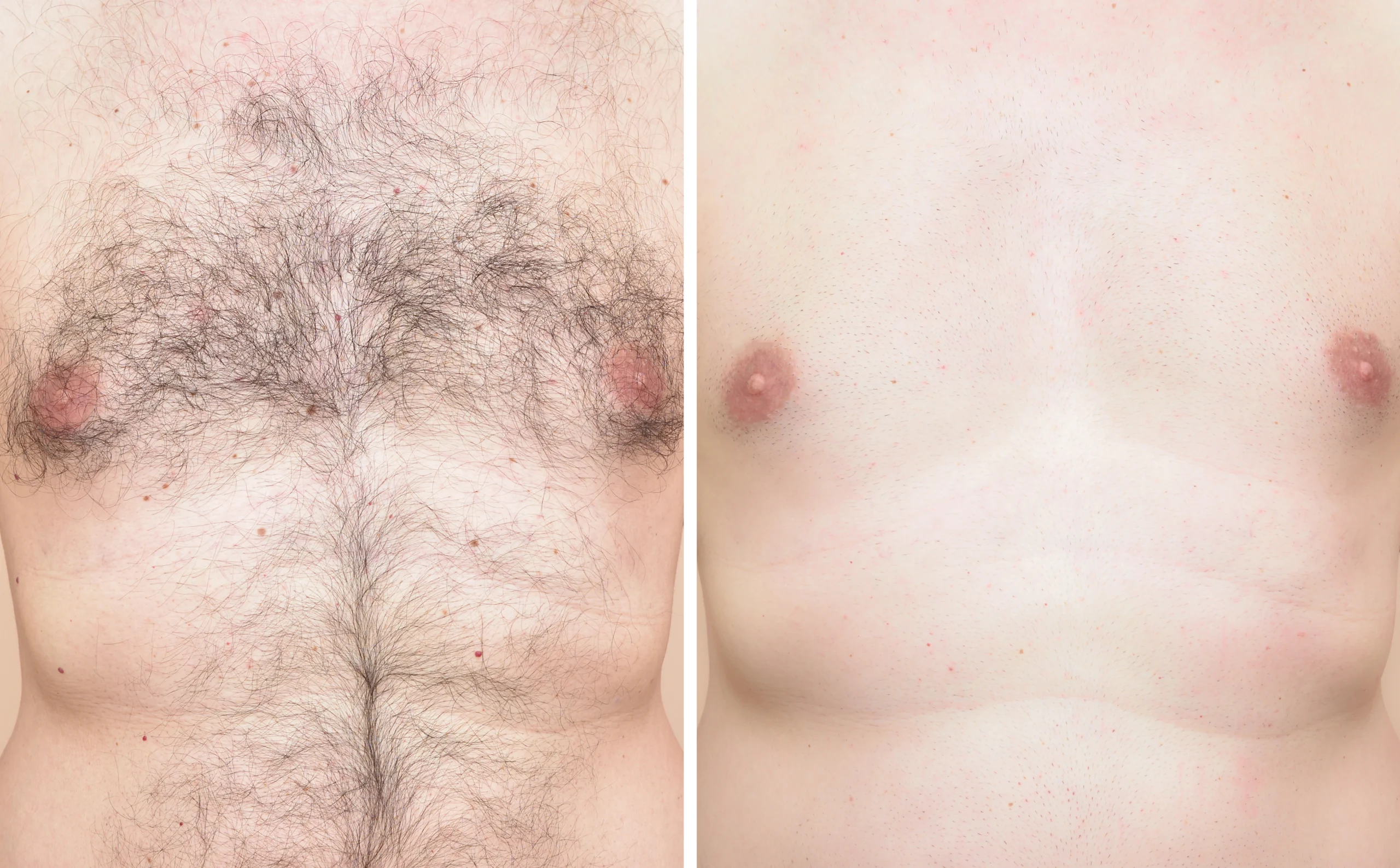 Alpha_Medical_Aesthetics_Lumenis_SplendorX_Laser_Hair_Removal_Summerlin_Las_Vegas Alpha_Medical_Aesthetics_Lumenis_SplendorX_Laser_Hair_Removal_Summerlin_Las_Vegas