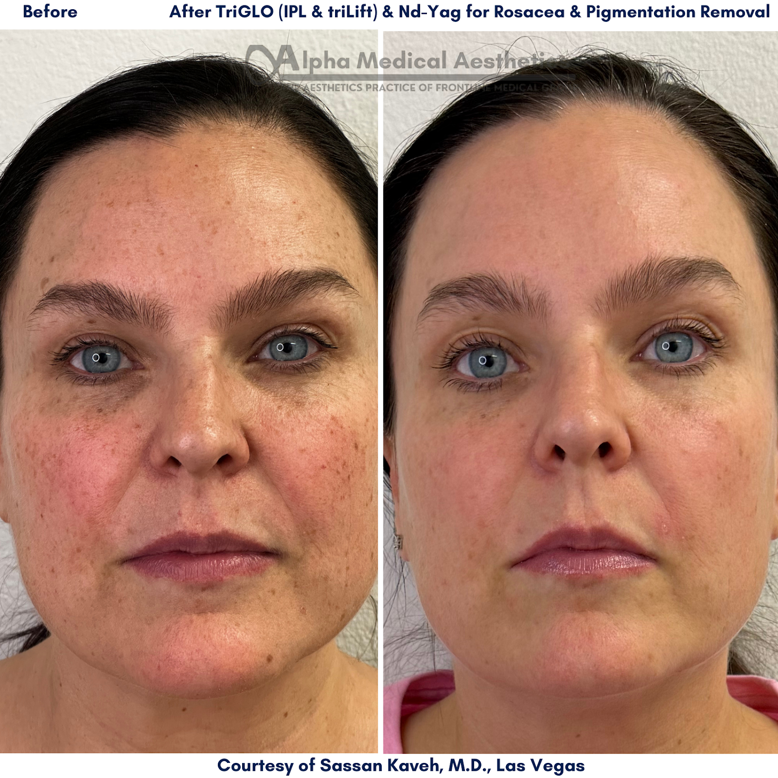 Alpha Medical Aesthetics IPL And TriLift Combination Package Dr Sassan Kaveh Las Vegas Alpha Medical Aesthetics IPL And TriLift Combination Package Dr Sassan Kaveh Las Vegas