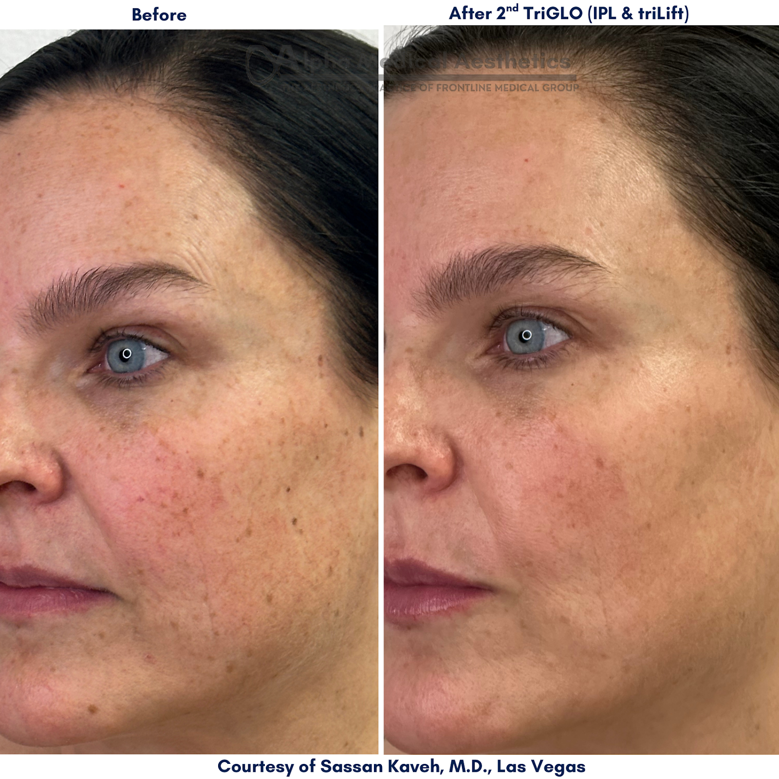 Alpha Medical Aesthetics IPL Treatment To Brown Spots Removal Centennial Hills Las Vegas Alpha Medical Aesthetics IPL Treatment To Brown Spots Removal Centennial Hills Las Vegas