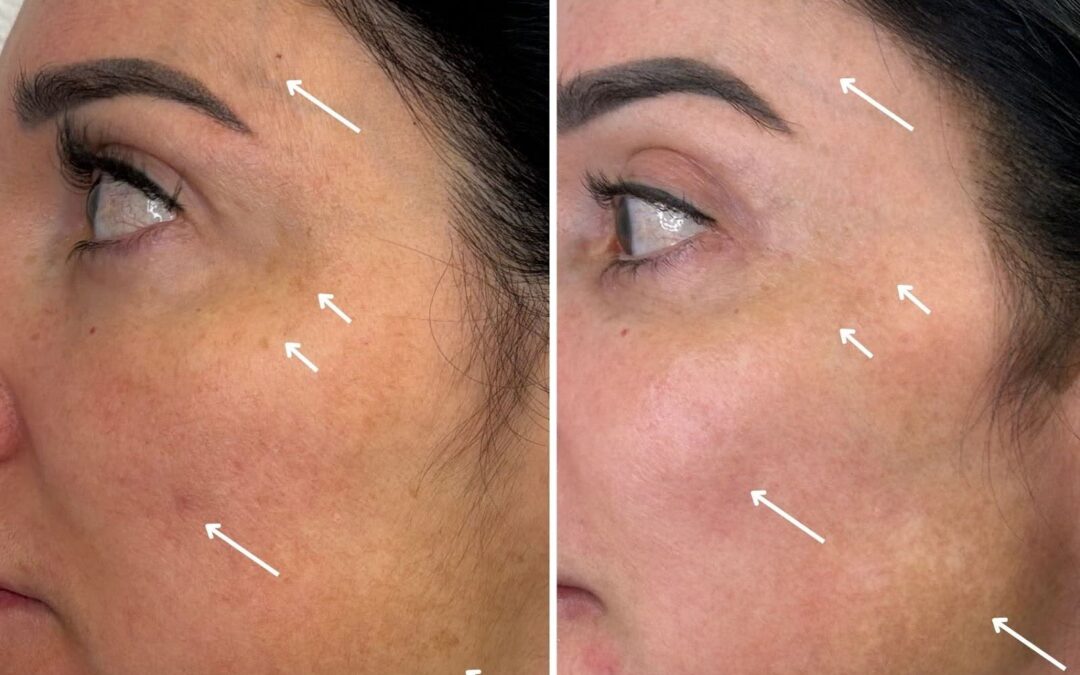 How Photofractional Treatments Unfold in Las Vegas