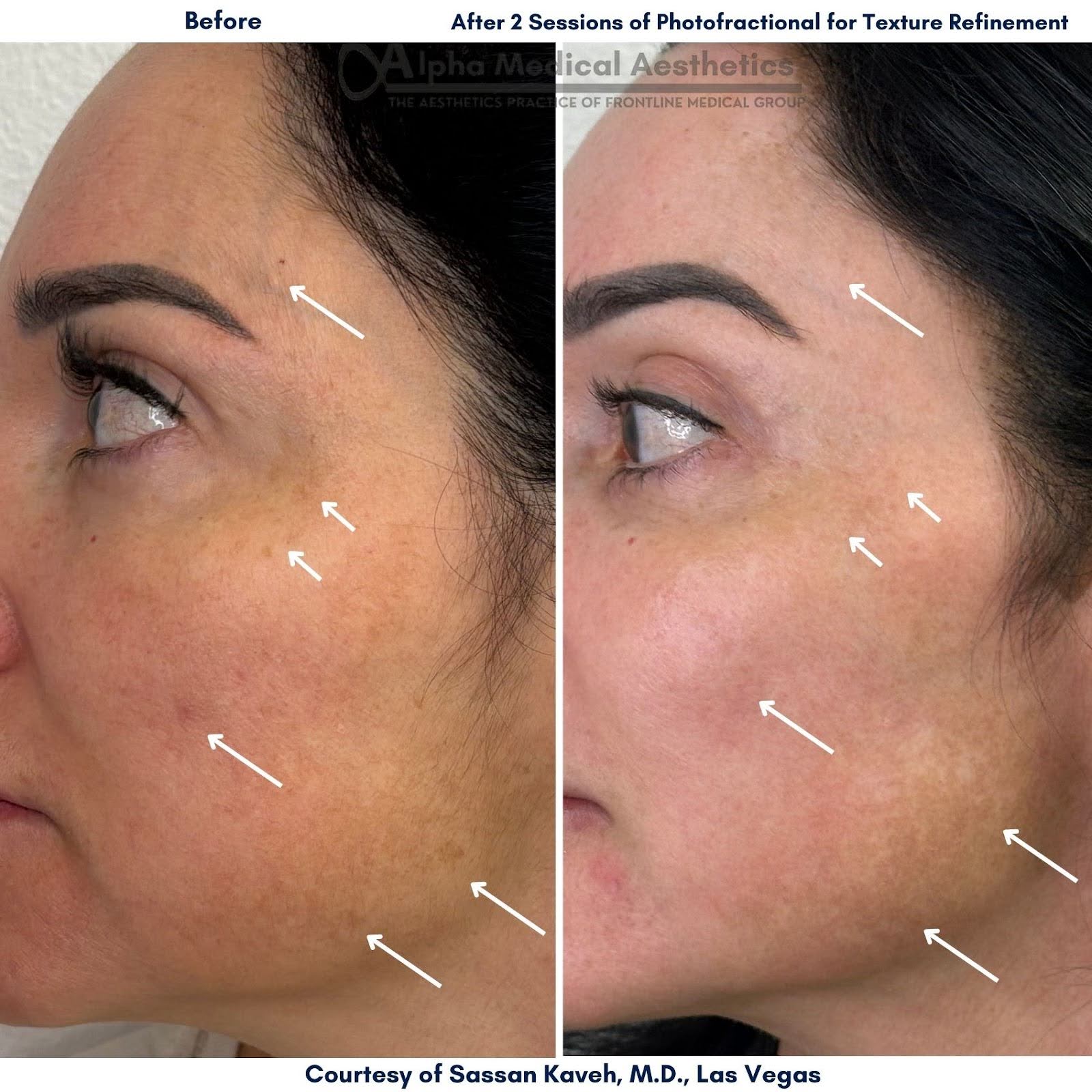 Alpha Medical Aesthetics Lumenis Photofractional For Texture Refinement Dr Sassan Kaveh Las Vegas Alpha Medical Aesthetics Lumenis Photofractional For Texture Refinement Dr Sassan Kaveh Las Vegas