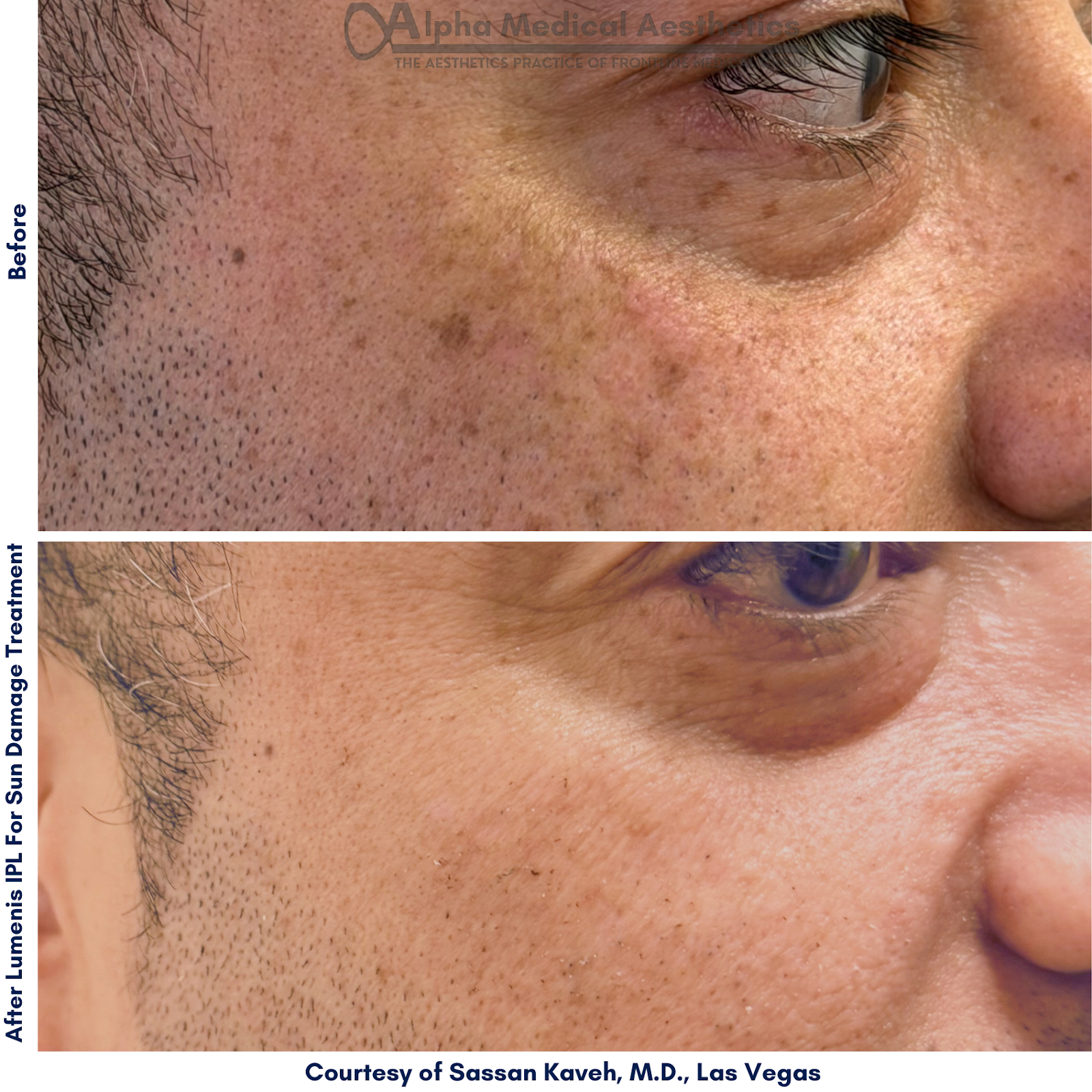 Alpha Medical Aesthetics Lumenis Stellar M22 IPL Therapy To Treat Sun Damage Desert Shores Las Vegas