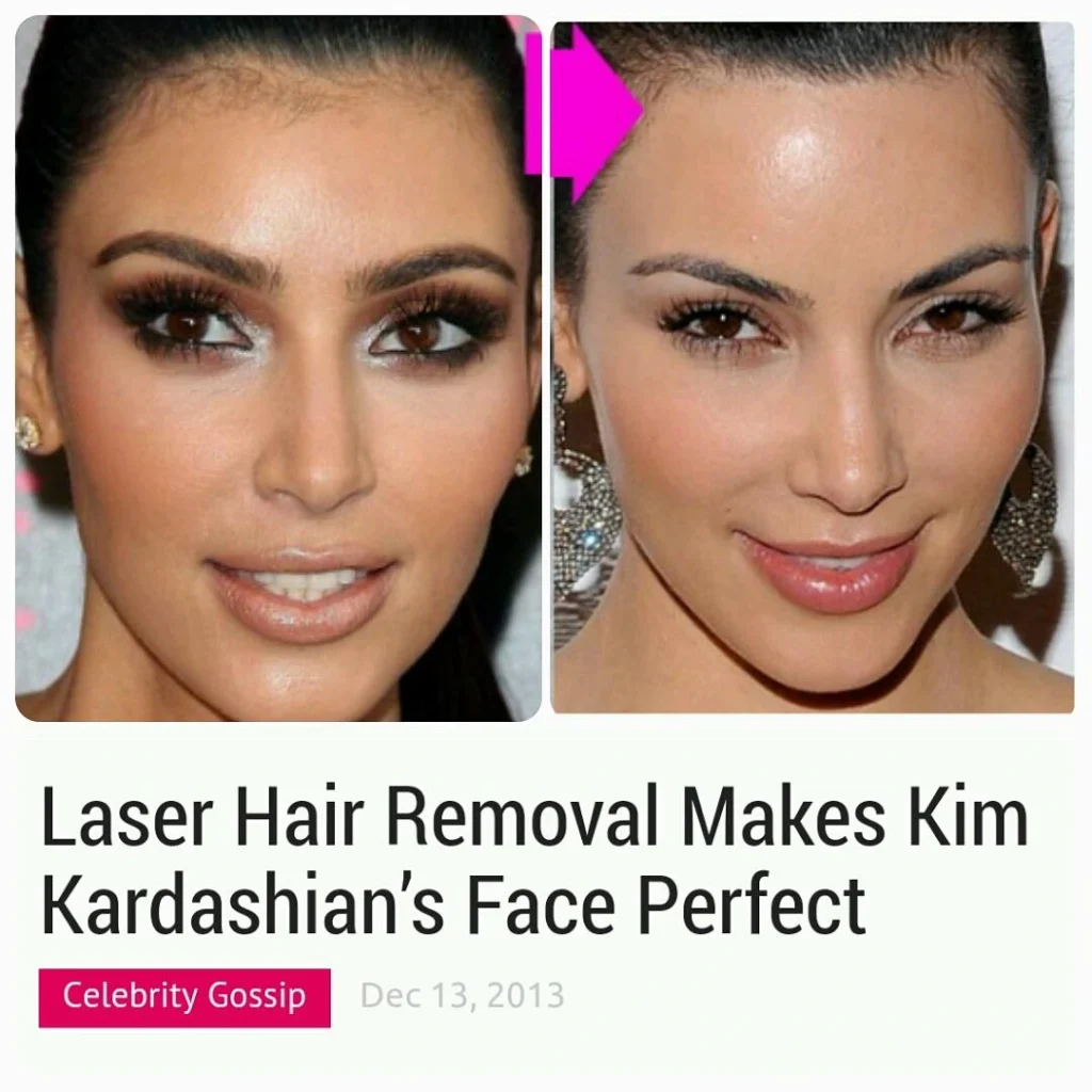 Kardashians Laser Hair Removal Alpha_Medical_Aesthetics_Lumenis_SplendorX_Laser_Hair_Removal_By_Dr._Sassan_Kaveh_Summerlin_Las_Vegas