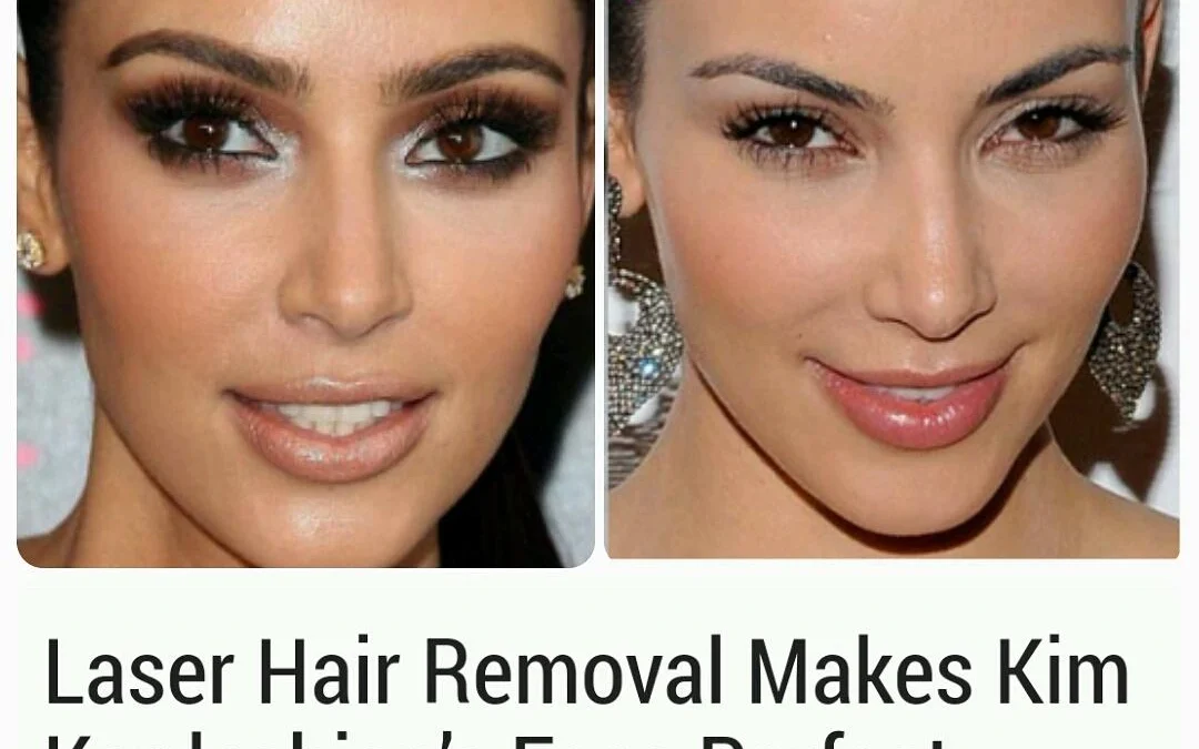 Where Do the Kardashians Go for Laser Hair Removal?
