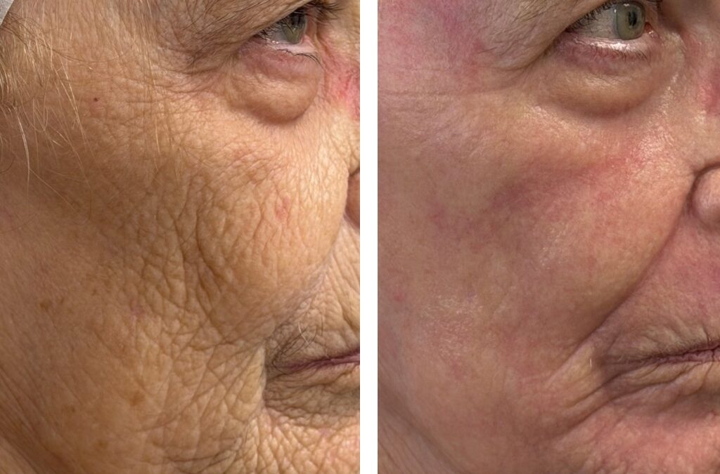 CO2 Laser Downtime