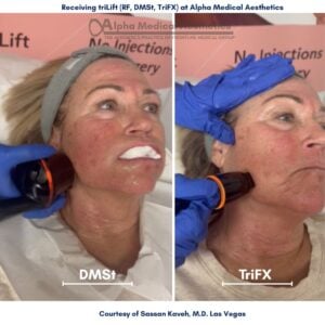 Alpha_Medical_Aesthetics_Lumenis_triLift_Dr._Sassan_Kaveh_Las_Vegas Alpha_Medical_Aesthetics_Lumenis_triLift_Dr._Sassan_Kaveh_Las_Vegas