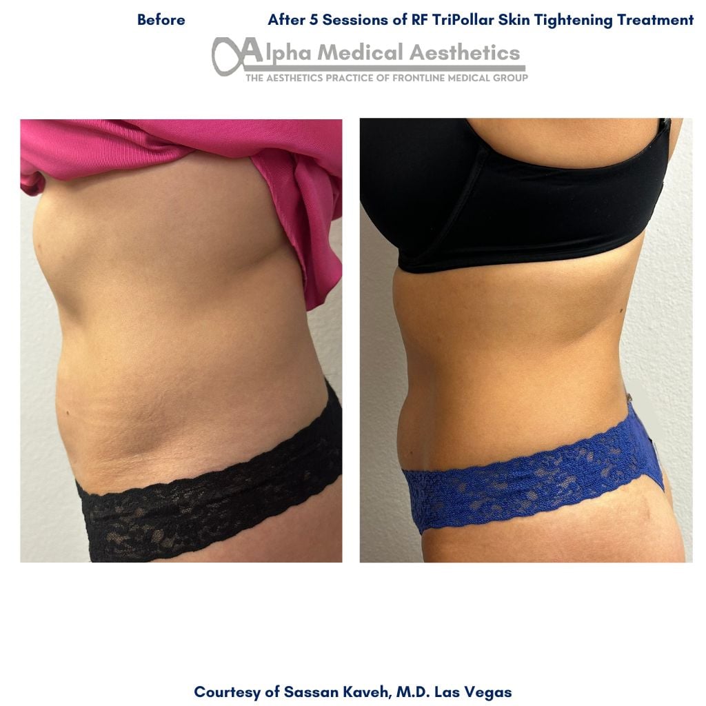 Alpha_Medical_Aesthetics_Lumenis_RF_Skin_Tightening_Before_and_After_Pictures_Dr._Sassan_Kaveh_20-Minutes_From_Henderson Alpha_Medical_Aesthetics_Lumenis_RF_Skin_Tightening_Before_and_After_Pictures_Dr._Sassan_Kaveh_20-Minutes_From_Henderson