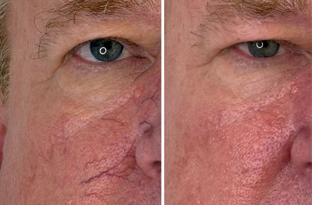 Vascular Lesions Removal on the Face