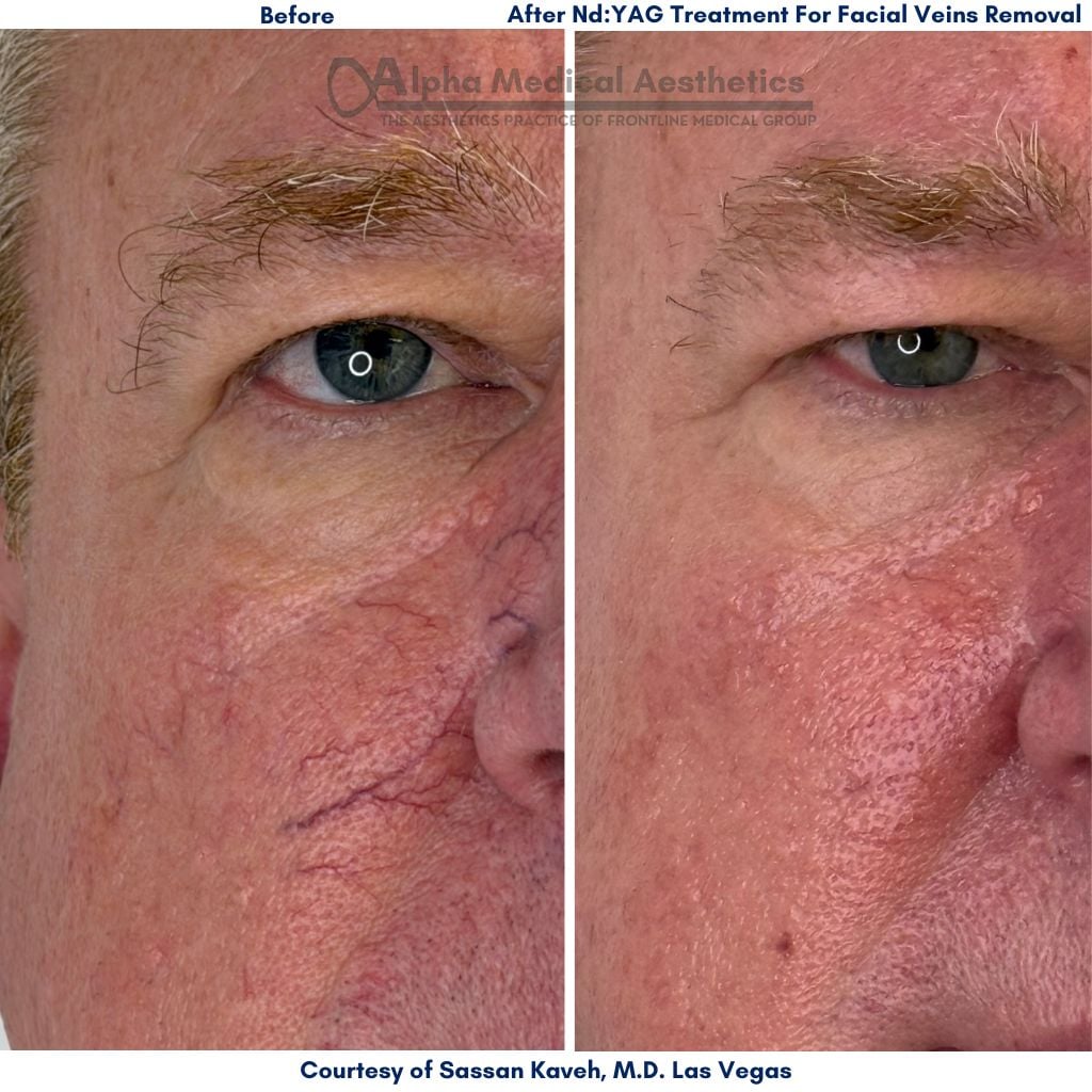 Vascular Lesions Treatment by Nd Yag