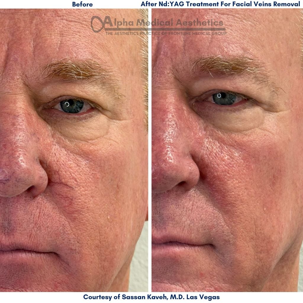 Vascular Lesions Treatment by Nd Yag