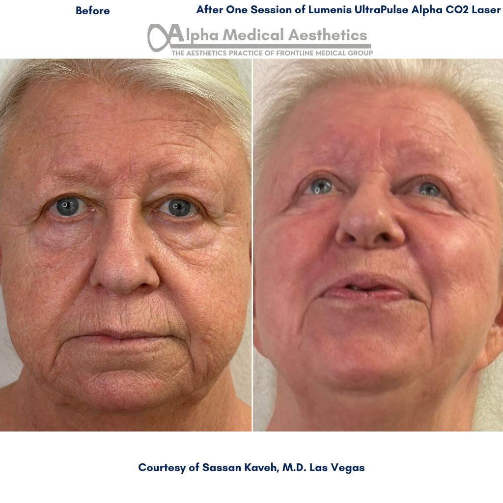 Alpha_Medical_Aesthetics_Lumenis_UltraPulse_Alpha_CO2_Laser_Before_and_After_Picture_By_Dr._Sassan_Kaveh_Desert_Shores_Las_Vegas Alpha_Medical_Aesthetics_Lumenis_UltraPulse_Alpha_CO2_Laser_Before_and_After_Picture_By_Dr._Sassan_Kaveh_Desert_Shores_Las_Vegas