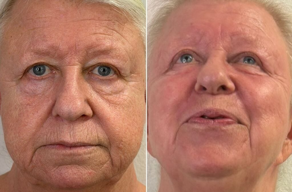 Laser Skin Tightening Las Vegas: Cost, Results, and Best Devices for 2026
