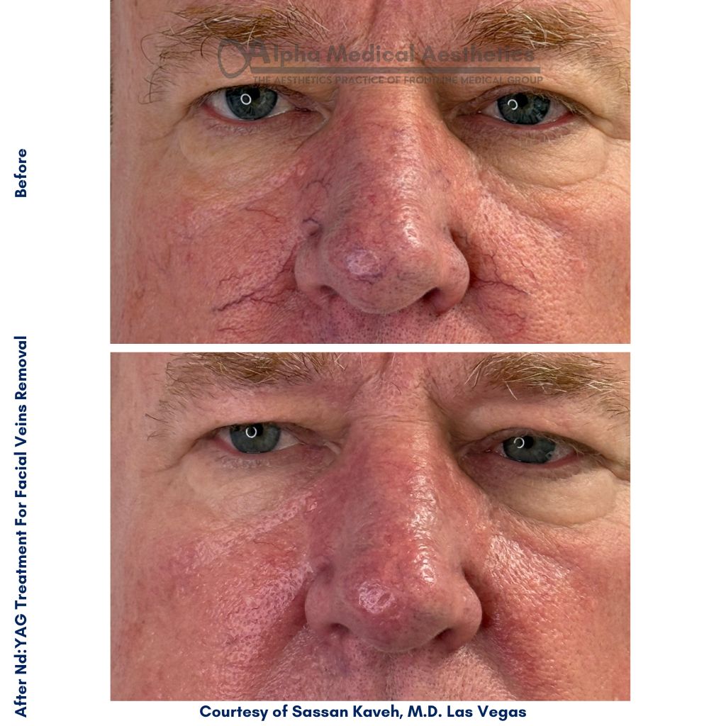 Alpha_Medical_Aesthetics_NdYAG_Facial_Vein_Removal_Dr._Sassan_Kaveh_Las_Vegas Alpha_Medical_Aesthetics_NdYAG_Facial_Vein_Removal_Dr._Sassan_Kaveh_Las_Vegas