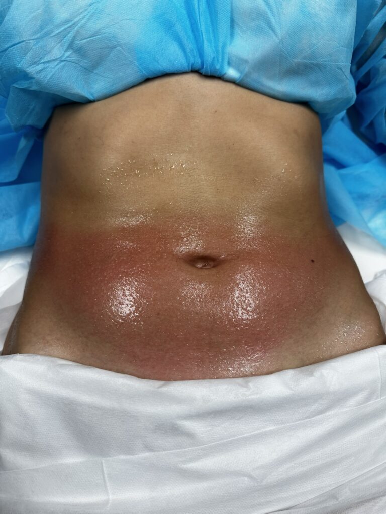 Alpha_Medical_Aesthetics_Lumenis_RF_Skin_Tightening_Treatment_Dr._Sassan_Kaveh_20-Minutes_From_Henderson Alpha_Medical_Aesthetics_Lumenis_RF_Skin_Tightening_Treatment_Dr._Sassan_Kaveh_20-Minutes_From_Henderson