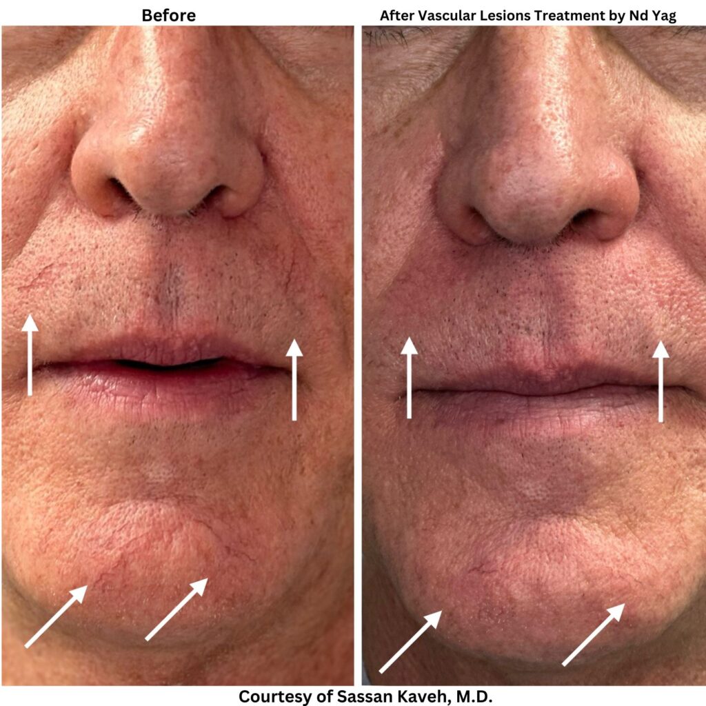 Alpha_Medical_Aesthetics_Vascular-Lesions-Treatment-by-Nd-Yag.jpg Alpha_Medical_Aesthetics_Vascular-Lesions-Treatment-by-Nd-Yag.jpg