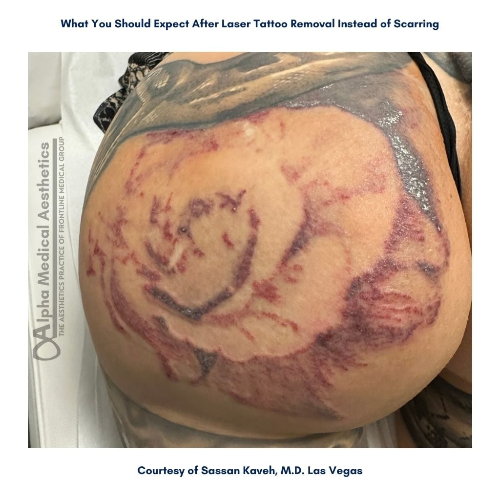 Alpha_Medical_Aesthetics_What_to_Expect_After_Tattoo_Removal_Dr._Sassan_Kaveh_Las Vegas Alpha_Medical_Aesthetics_What_to_Expect_After_Tattoo_Removal_Dr._Sassan_Kaveh_Las Vegas