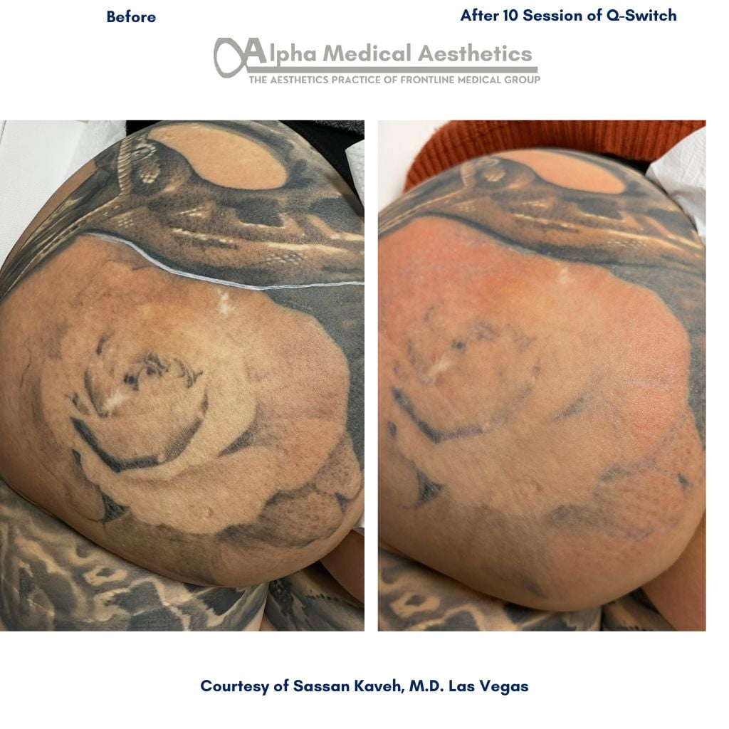 Alpha_Medical_Aesthetics_Lumenis_Q_Switch_Tattoo_Removal_Dr._Sassan_Kaveh_Las_Vegas Alpha_Medical_Aesthetics_Lumenis_Q_Switch_Tattoo_Removal_Dr._Sassan_Kaveh_Las_Vegas