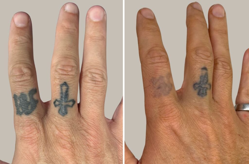 What Most People Get Wrong About Laser Tattoo Removal and Scarring
