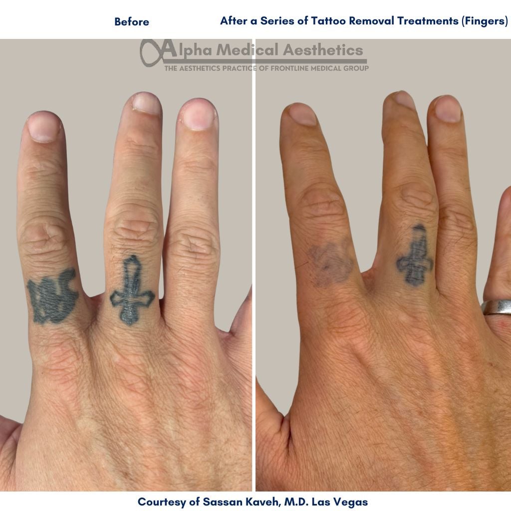 Tattoo Removal and Scarring