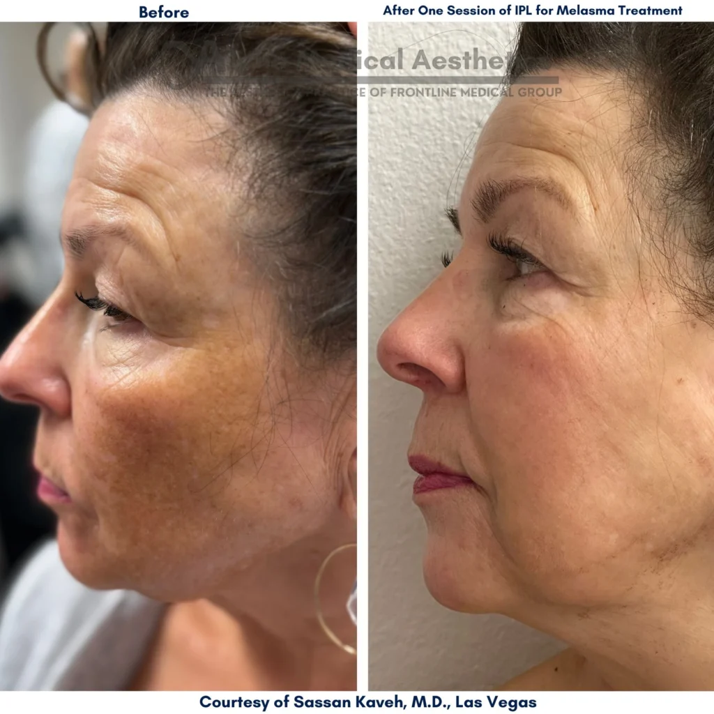 Alpha_Medical_Aesthetics_Lumenis_IPL_Melasma_Treatment_in_Las Vegas_Before_And_After_By_Dr._Sassan_Kaveh Alpha_Medical_Aesthetics_Lumenis_IPL_Melasma_Treatment_in_Las Vegas_Before_And_After_By_Dr._Sassan_Kaveh