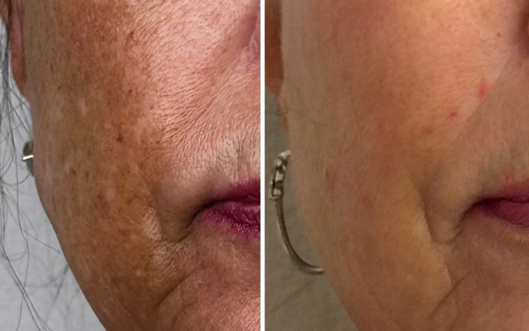 Melasma Treatment in Las Vegas: Why It Keeps Coming Back and How to Actually Fix It