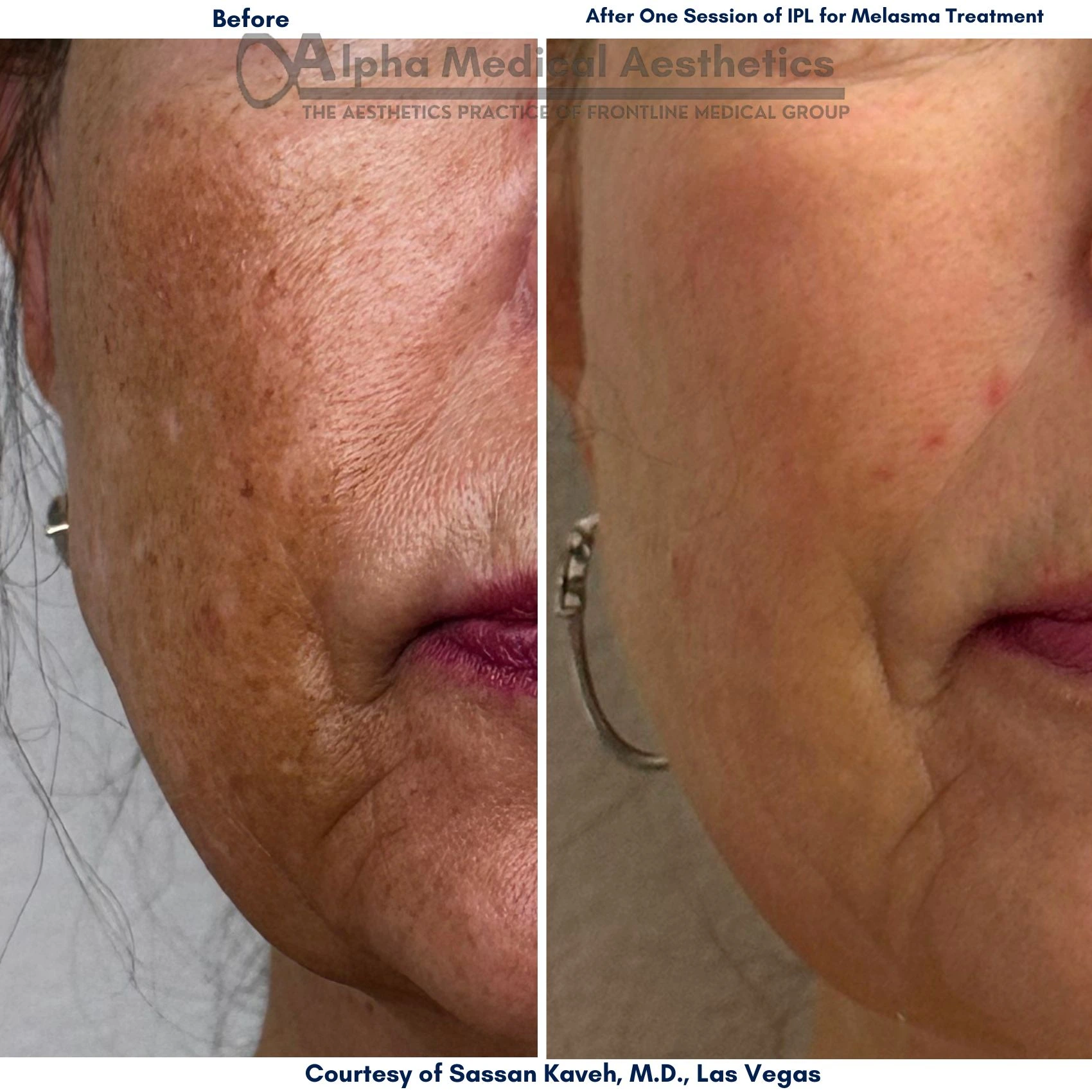 Alpha_Medical_Aesthetics_Lumenis_IPL_Stellar_M22_Melasma_Treatment_in_Las Vegas_Dr._Sassan_Kaveh
