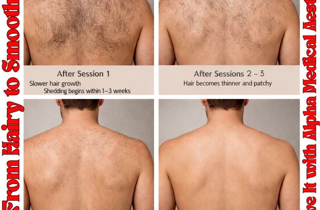 How Many Laser Hair Removal Sessions Do You Really Need for Dramatic, Long Lasting Results?