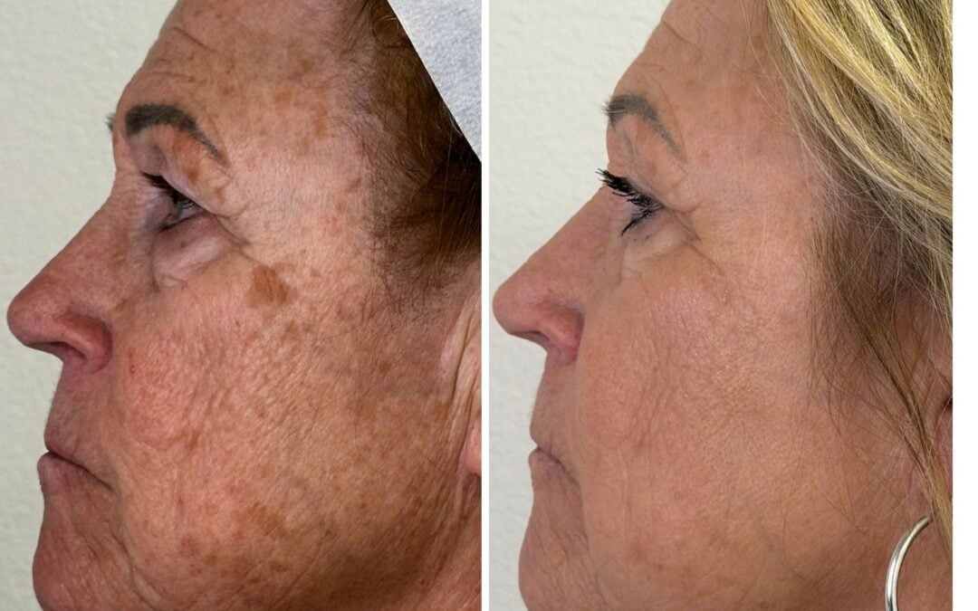 How to Choose the Right Treatment for Sun Damage in Las Vegas