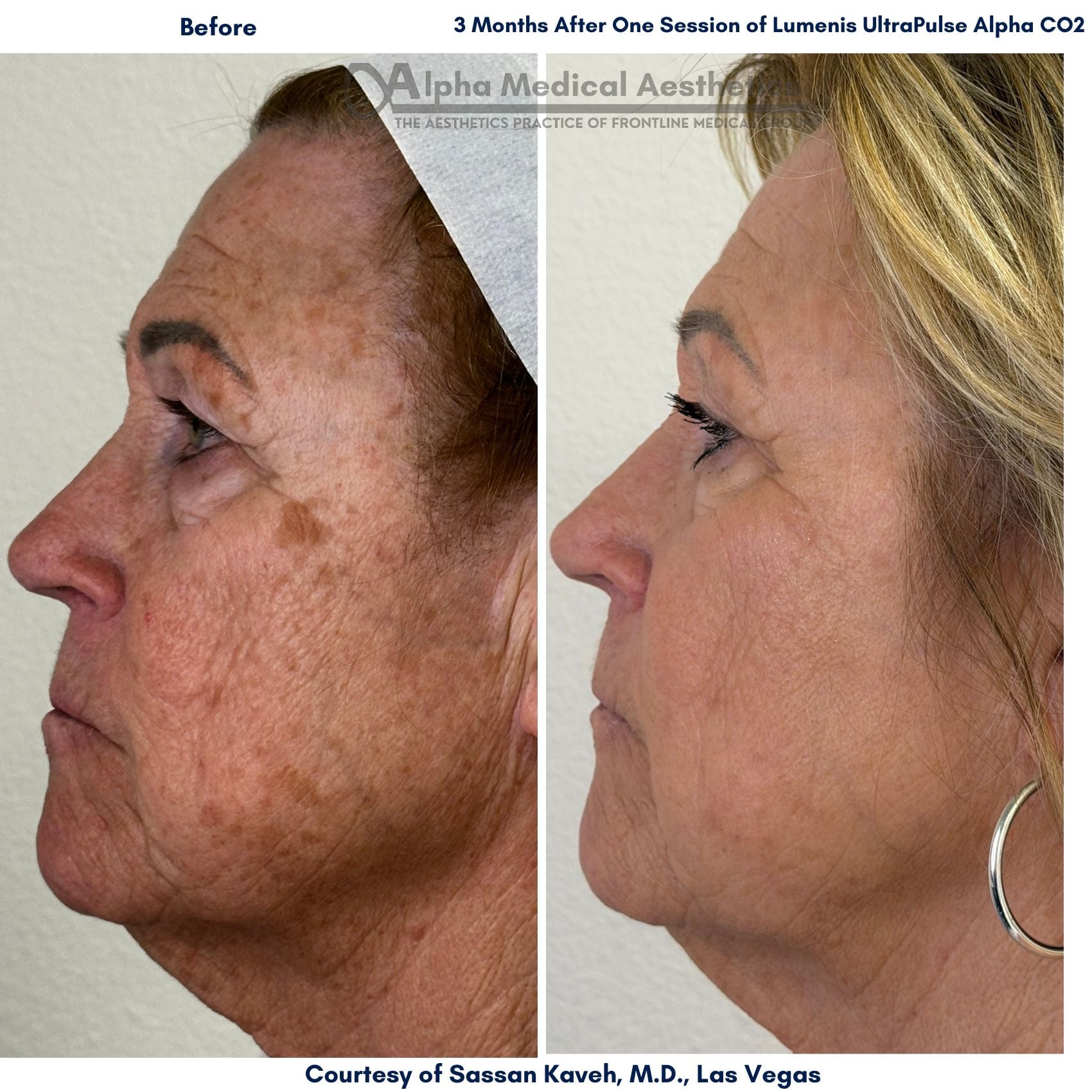 Alpha_Medical_Aesthetics_Lumenis_UltraPulse_Alpha_CO2_Laser_Before_and_After_Picture_Dr._Sassan_Kaveh_Henderson