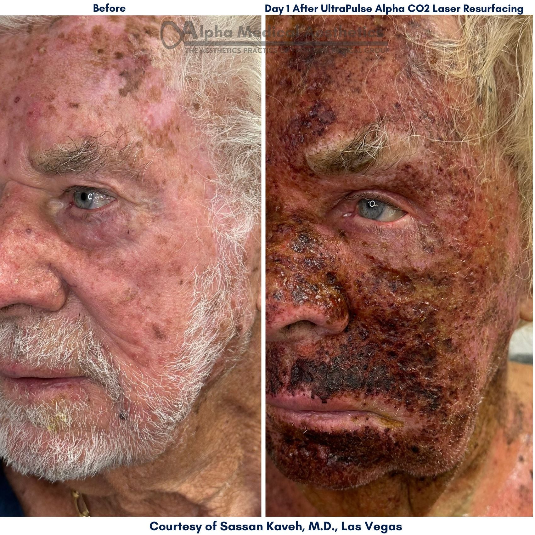 Alpha_Medical_Aesthetics_Lumenis_UltraPulse_Alpha_CO2_Laser_Treatment_Before_And_1-Day_After_By_Dr._Sassan_Kaveh_Las_Vegas