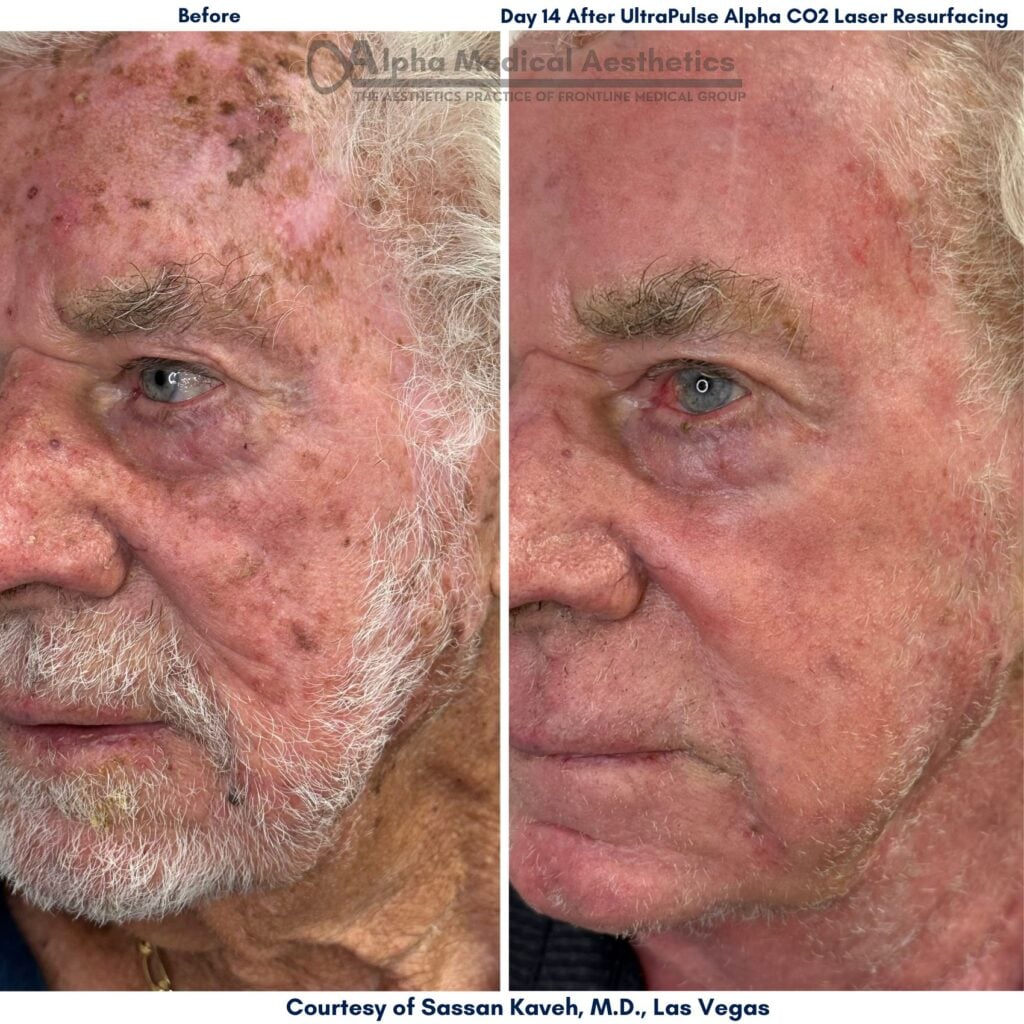 Alpha_Medical_Aesthetics_Lumenis_UltraPulse_Alpha_CO2_Laser_Treatment_Before_And_14-Days_After_By_Dr._Sassan_Kaveh_Las_Vegas Alpha_Medical_Aesthetics_Lumenis_UltraPulse_Alpha_CO2_Laser_Treatment_Before_And_14-Days_After_By_Dr._Sassan_Kaveh_Las_Vegas