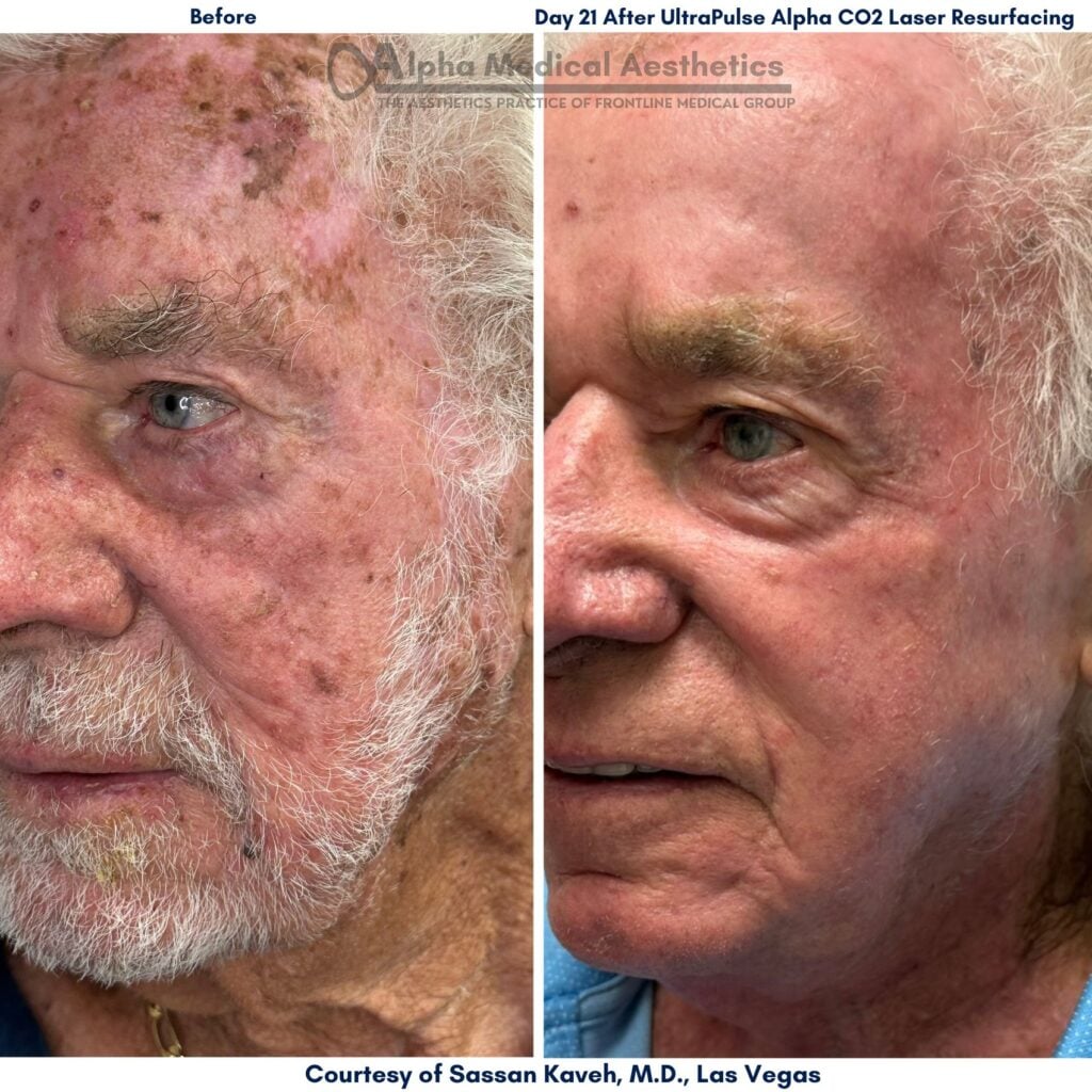 Alpha_Medical_Aesthetics_Lumenis_UltraPulse_Alpha_CO2_Laser_Treatment_Before_And_21-Days_After_By_Dr._Sassan_Kaveh_Las_Vegas Alpha_Medical_Aesthetics_Lumenis_UltraPulse_Alpha_CO2_Laser_Treatment_Before_And_21-Days_After_By_Dr._Sassan_Kaveh_Las_Vegas