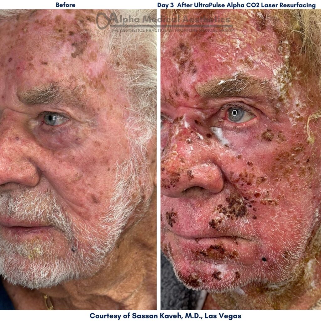 Alpha_Medical_Aesthetics_Lumenis_UltraPulse_Alpha_CO2_Laser_Treatment_Before_And_3-Days_After_By_Dr._Sassan_Kaveh_Las_Vegas Alpha_Medical_Aesthetics_Lumenis_UltraPulse_Alpha_CO2_Laser_Treatment_Before_And_3-Days_After_By_Dr._Sassan_Kaveh_Las_Vegas