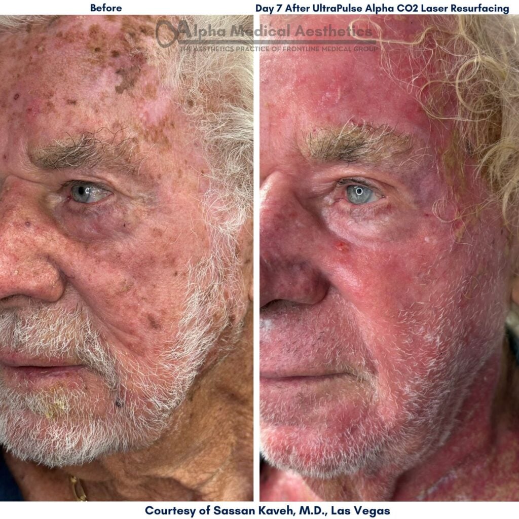 Alpha_Medical_Aesthetics_Lumenis_UltraPulse_Alpha_CO2_Laser_Treatment_Before_And_7-Days_After_By_Dr._Sassan_Kaveh_Las_Vegas Alpha_Medical_Aesthetics_Lumenis_UltraPulse_Alpha_CO2_Laser_Treatment_Before_And_7-Days_After_By_Dr._Sassan_Kaveh_Las_Vegas