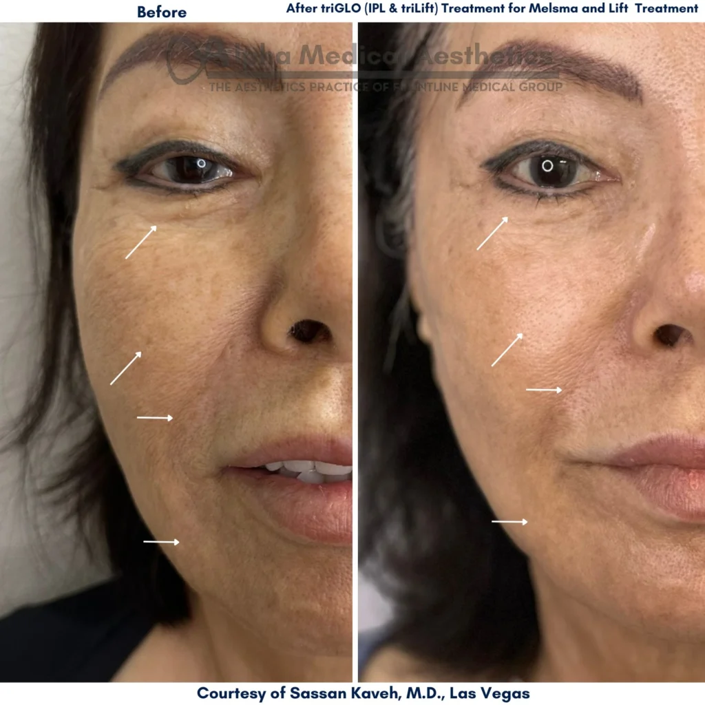 Alpha_Medical_Aesthetics_Melasma_Treatment_in_Las Vegas_Before_And_After_By_Dr._Sassan_Kaveh Alpha_Medical_Aesthetics_Melasma_Treatment_in_Las Vegas_Before_And_After_By_Dr._Sassan_Kaveh