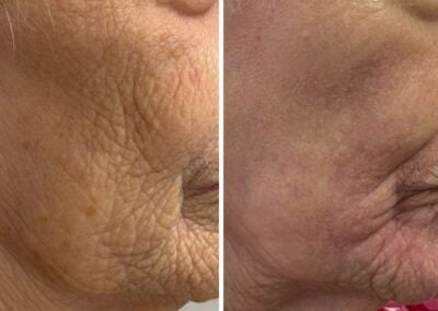 Alpha_Medical_Aesthetics_SmoothGLO_And_Lumenis_UltraPulse_Alpha_CO2_Laser_Combination_Right_Treatment_For_Sun_Damage_By_Sassan_Kaveh_Las_Vegas