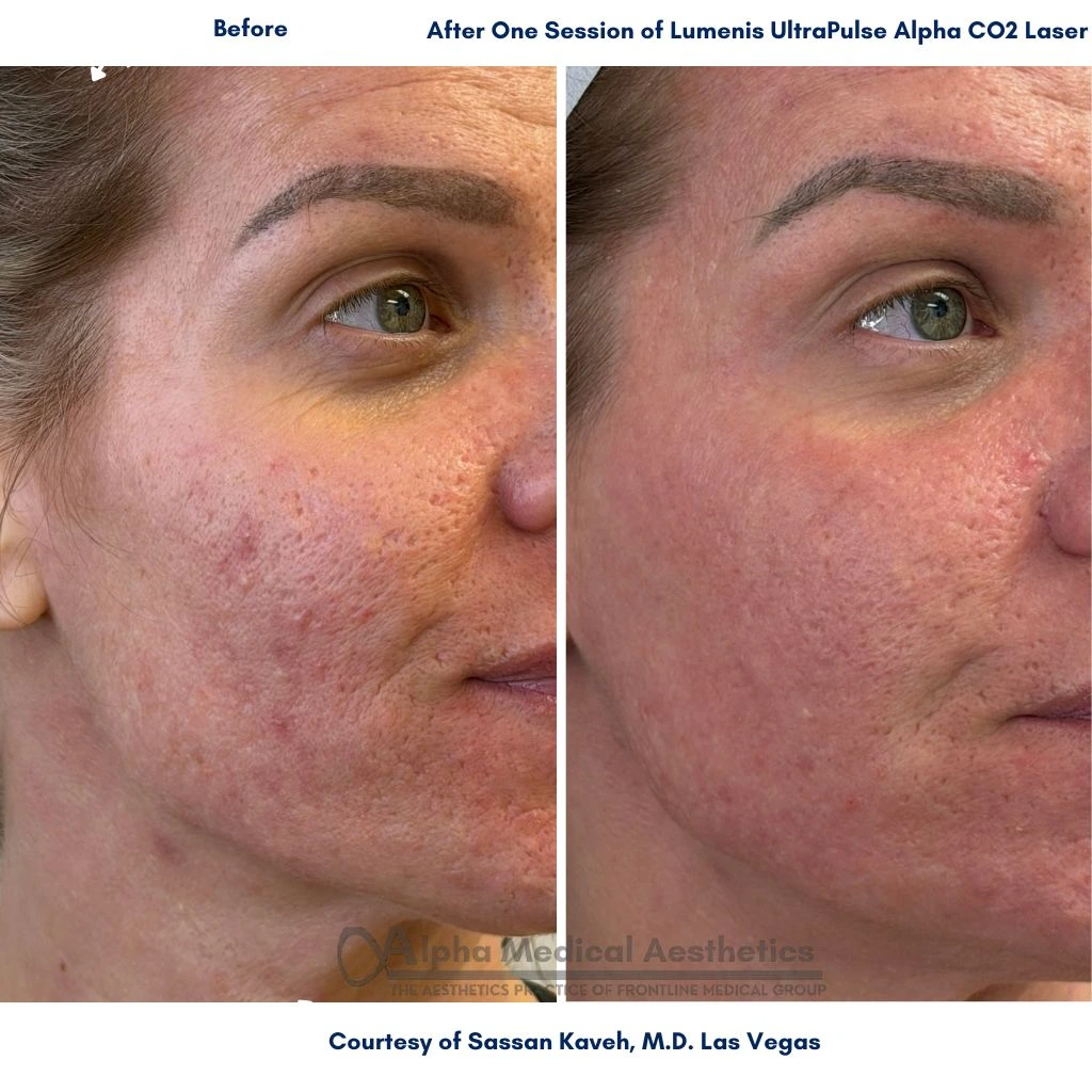 Alpha_Medical_Aesthetics_Acne-Scar-Treatment-Before-After-Las-Vegas_Dr._Sassan_Kaveh Alpha_Medical_Aesthetics_Acne-Scar-Treatment-Before-After-Las-Vegas_Dr._Sassan_Kaveh
