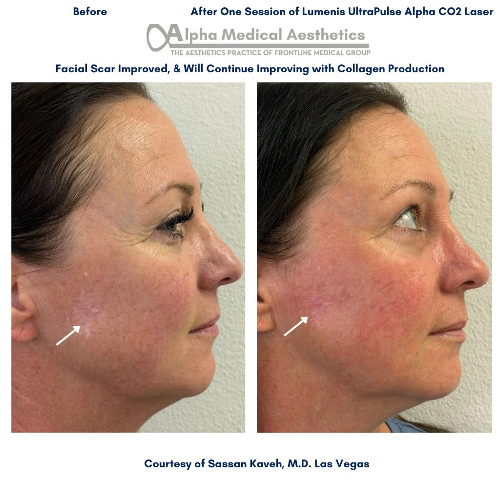Alpha_Medical_Aesthetics_Facial-Scar-Removal-Las_Vegas_Before_And_After Alpha_Medical_Aesthetics_Facial-Scar-Removal-Las_Vegas_Before_And_After