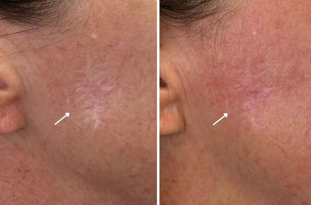 Facial Scar Removal in Las Vegas: What Actually Works for Acne Scars, Surgical Scars, and Texture