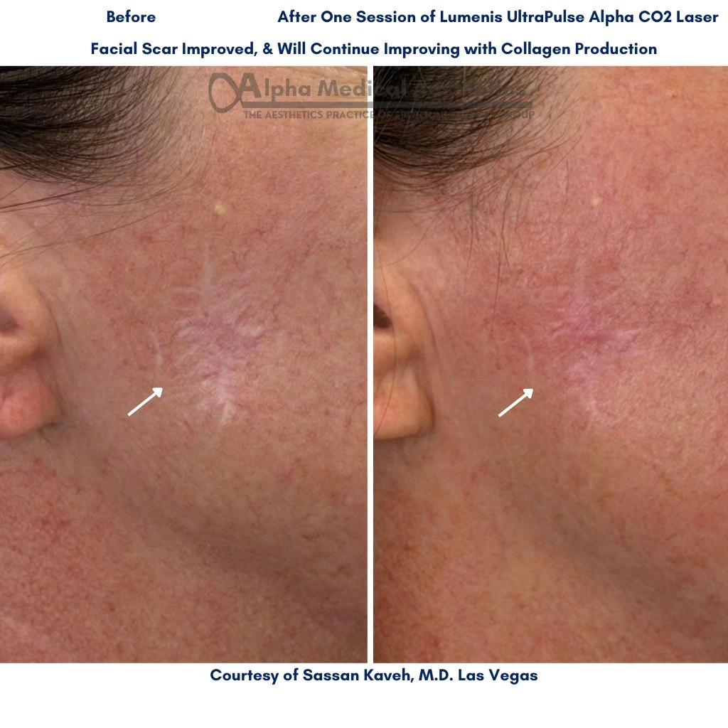 Alpha_Medical_Aesthetics_Facial-Scar-Removal-in_Las_Vegas_Dr._Sassan_Kaveh